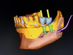 Si possono inserire impianti senza fare la TAC dentale