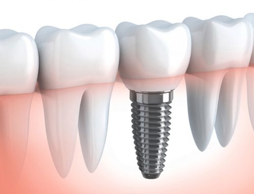 Cosa è importante sapere riguardo alle terapie implantari