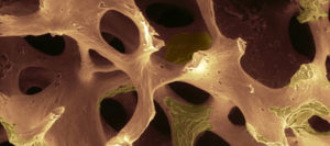 Bisfosfonati: cosa sono e perché è importante comunicarne l’assunzione al proprio odontoiatra