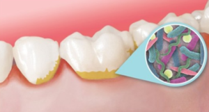 perchè il tartato va rimosso