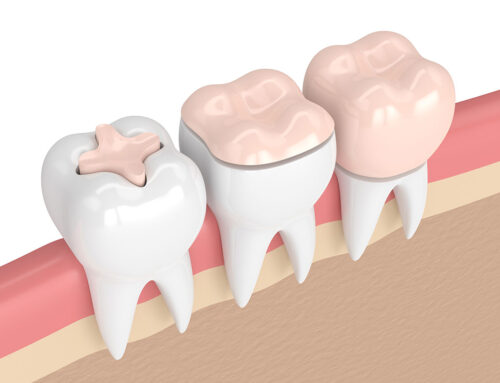 Intarsio dentale e Corona protesica quali sono le differenze