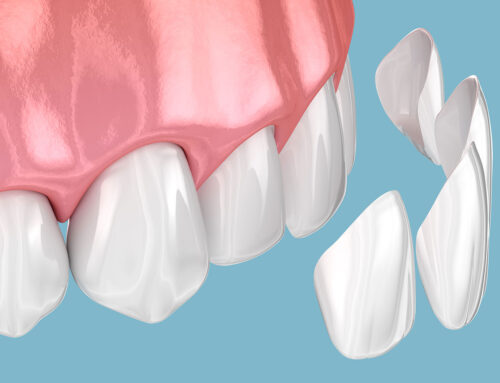 Faccette dentali: il segreto per un sorriso impeccabile