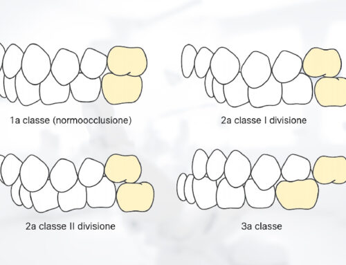 Classi dento-scheletriche: cosa sono e perché è importante avere una corretta occlusione