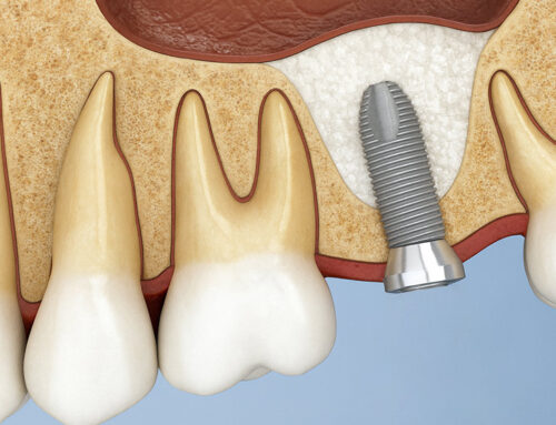 Rialzo di seno: la tecnica che rende possibile l’impianto anche in caso di poco osso