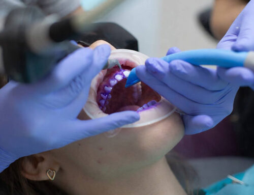 Igiene Orale GBT (Guided Biofilm Therapy): che cos’è e perché sta cambiando la pulizia dei denti